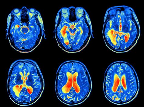 the villages mri scan brain|Neurosciences .